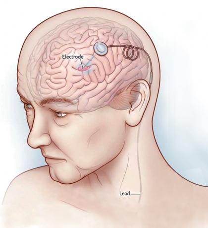 大脑也能装起搏器？